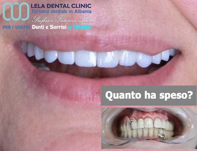 estetica-dentale-con-2-All-on-Six-tutto-su-12-impianti-dentali-e-24-corone-in-zirconio-in-Albania-a-Tirana