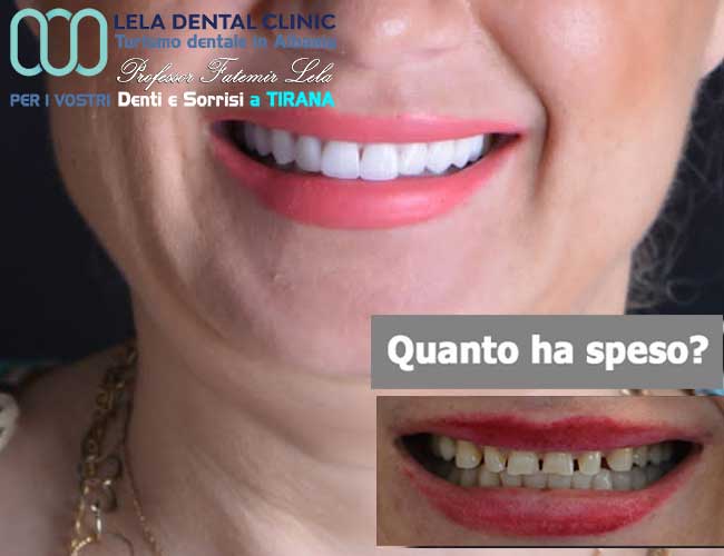 estetica-dentale-senza-cure-dentali-di-24-corone-in-zirconio-applicate-sui-propri-denti-in-Albania-a-Tirana