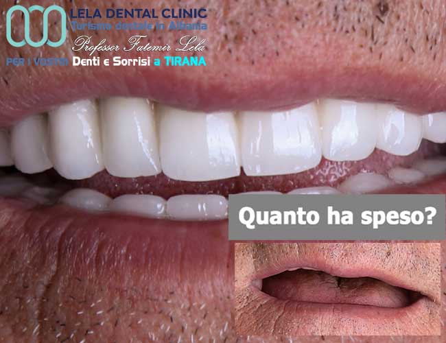 estrazione-dei-denti-con-implantologia-di-12-impianti-dentali-con-corone-in-zirconio-in-Albania-a-Tirana