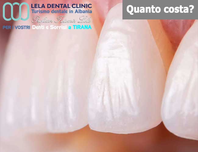 faccette-dentali-Emax-in-ceramica-integrale-in-Albania-a-tirana