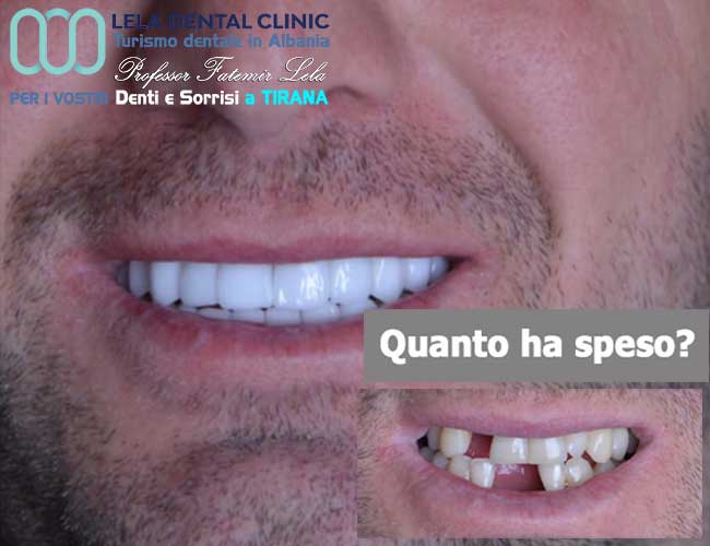 implantologia-di-4-impianti-dentali-con-cure-dentali-e-l'applicazione-di-24-corone-in-zirconio-in-Albania-a-Tirana