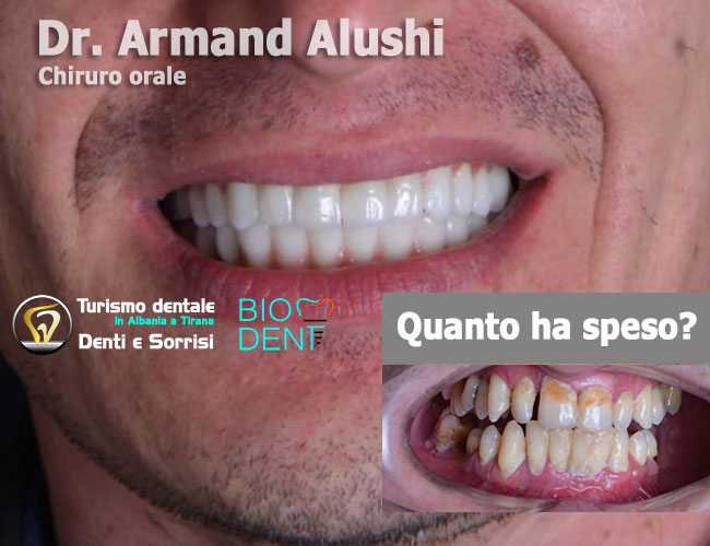 inserimento-di-3-impianti-dentali-più-cure-dei-denti-e-l'applicazione-di-24-corone-in-zirconio-in-Albania-a-Tirana