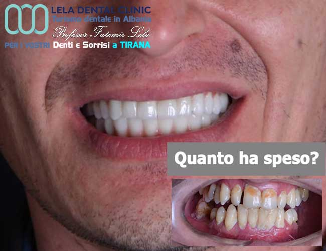 inserimento-di-3-impianti-dentali-più-cure-dei-denti-e-l'applicazione-di-24-corone-in-zirconio-in-Albania-a-Tirana