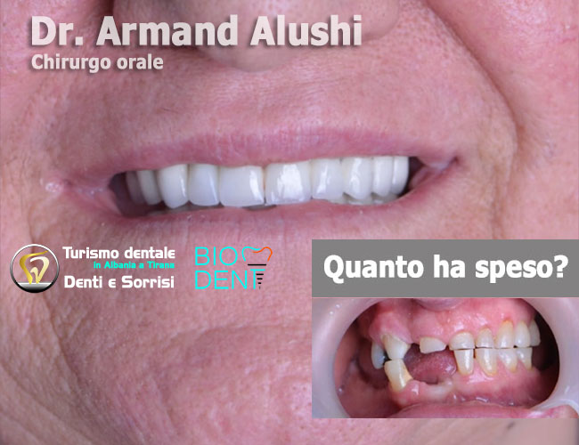 implantoligia-di-4-impianti-dentali-un-aumento-osseo-per-posizione-dente-e-24-corone-in-zirconio-in-Albania-a-Tirana