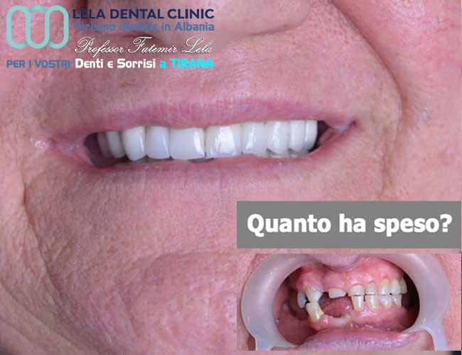 implantoligia-di-4-impianti-dentali-un-aumento-osseo-per-posizione-dente-e-24-corone-in-zirconio-in-Albania-a-Tirana