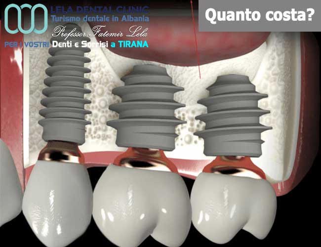 rialzo-del-seno-mascellare-e-riempimento-dell'osso-in-Albania-a-Tirana