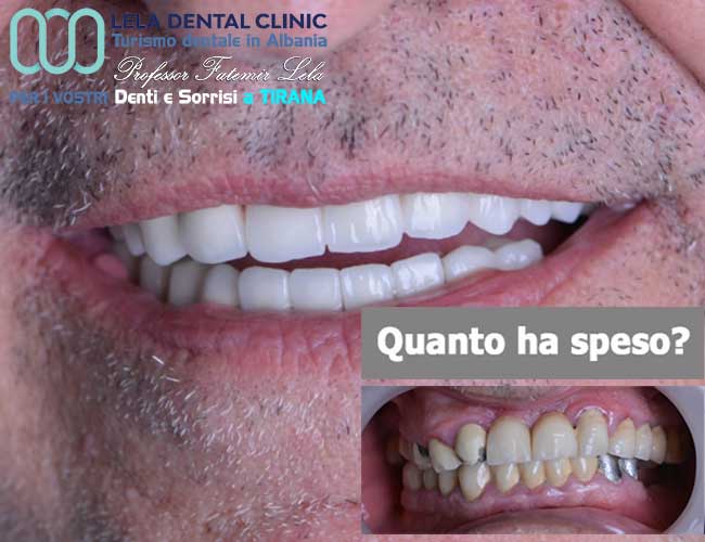 sostituzione-di-vecchie-corone-in-metallo-ceramica-con-24-corone-in-zirconio-con-cure-dentali-in-Albania-a-Tirana