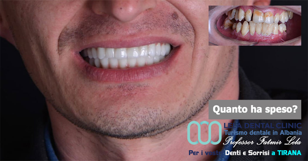 chirurgia-cure-dentali-e-24-corone-in-zirconio-albania-tirana