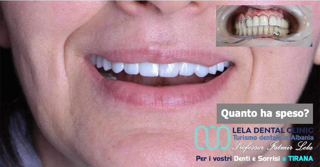 2-all-on-six-tutto-su-12-impianti-dentali-e-24-corone-in-zirconio