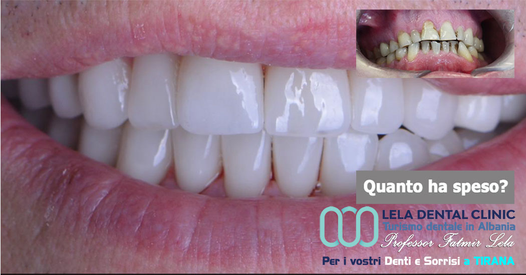 cure-canalarie-e-cure-carie-e-preparazione-dei-denti-con-limatura-per-l'applicazione-di-24-corone-in-zirconio