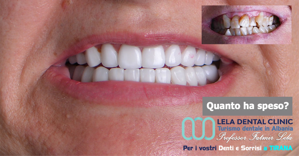 2-all-on-four-tutto-su-8-impianti-dentali-e-24-corone-in-zirconio