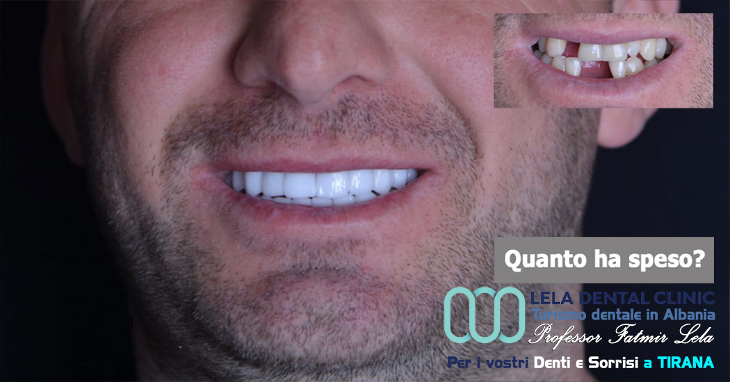 cure-dentali-e-denti-in-zirconio-albania-tirana