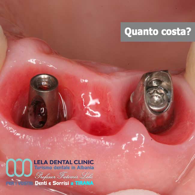 2-impianti-dentali-per-ponte-di-3-denti