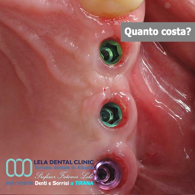 3-impianti-dentali-per-3-denti-singoli