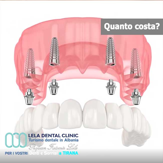 4-impianti-dentali-All-on-Four-vantaggi-e-svantaggi