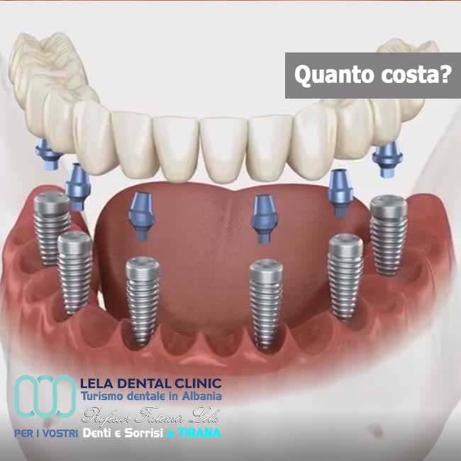 6-impianti-dentali-All-on-Six-vantaggi-e-svantaggi