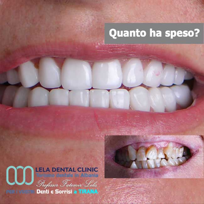 all-on-four-8-impianti-dentali-con-24-corone-in-zirconio