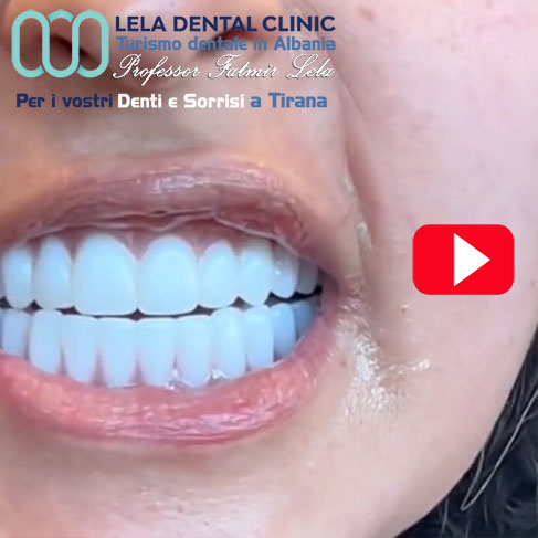 all-on-four-4-impianti-dentali-per-arcata