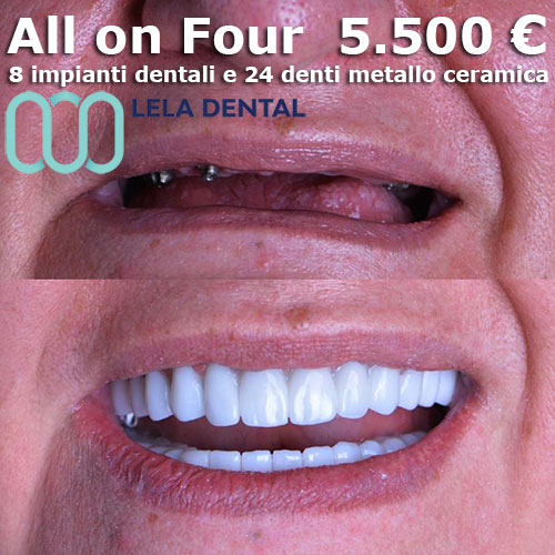 all-on-four-4-impianti-per-arcata-dentale