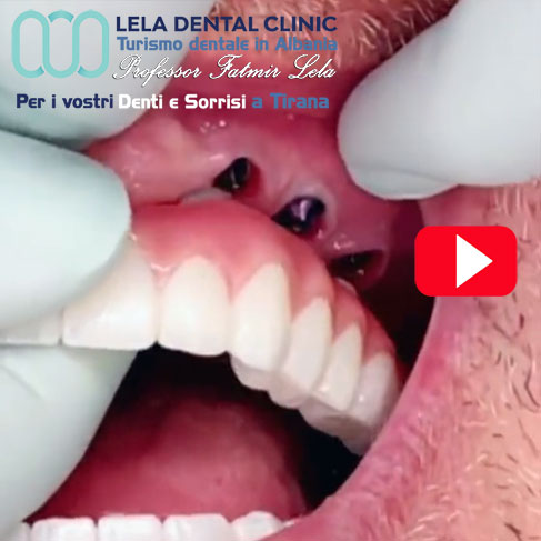 all-on-six-6-impianti-dentali-per-arcata