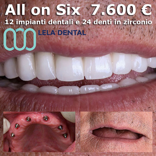 all-on-six-6-impianti-per-arcata-dentale