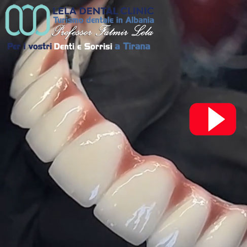 arcata-dentale-su-impianti-dentali