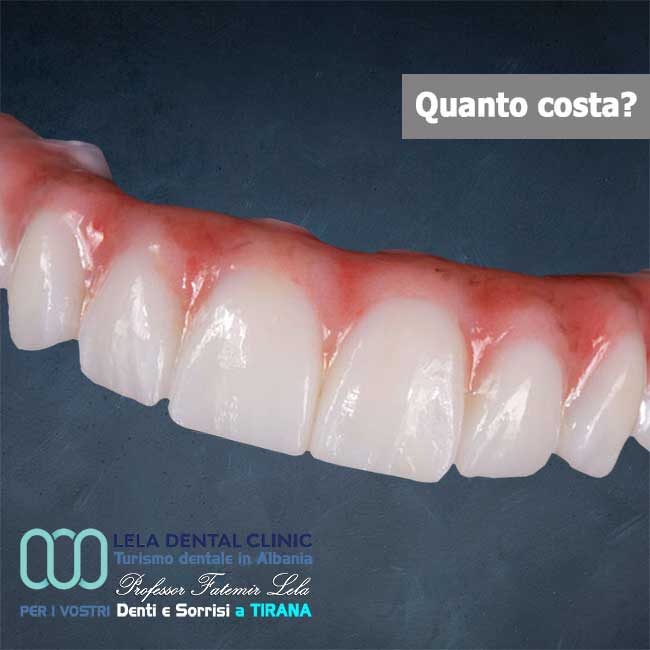 arcata-in-zirconio-con-gengive