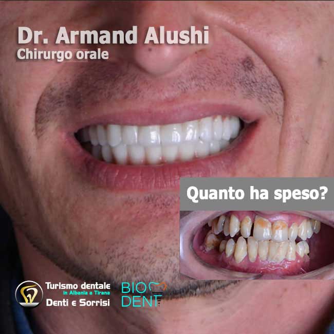 inserimento-di-3-impianti-dentali-più-cure-dei-denti-e-l'applicazione-di-24-corone-in-zirconio-in-albania-a-tirana