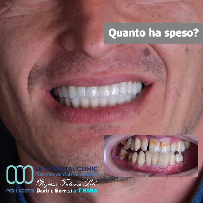 inserimento-di-3-impianti-dentali-più-cure-dei-denti-e-l'applicazione-di-24-corone-in-zirconio