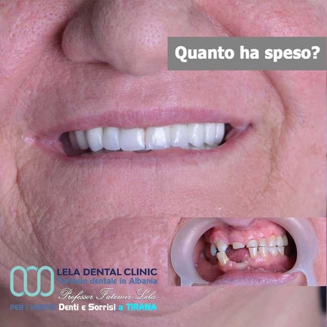 implantologia-di-4-impianti-dentali-un-aumento-osseo-per-posizione-dente-e-24-corone-in-zirconio