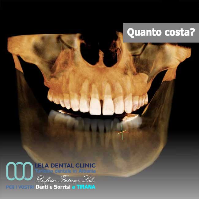 Dentista-in-Albania-con-clinica-dentale-a-Tirana-per-turismo-dentale-Esame-tac-3d-per-l'implantologia-e-chirurgia