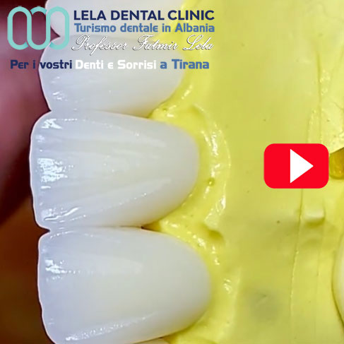 estetica-dentale-con-denti-in-zirconio