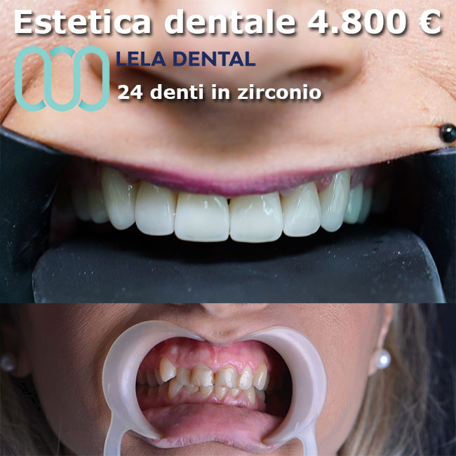 estetica-dentale-con-denti-in-zirconio