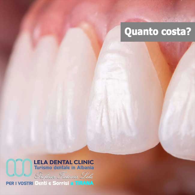 faccette-dentali-Emax