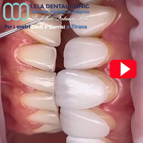 faccette-dentali-emax