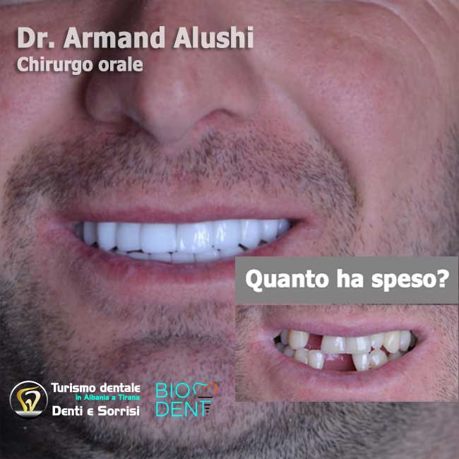 implantologia-di-4-impianti-dentali-con-cure-dentali-e-l'applicazione-di-24-corone-in-zirconio-in-albania-a-tirana
