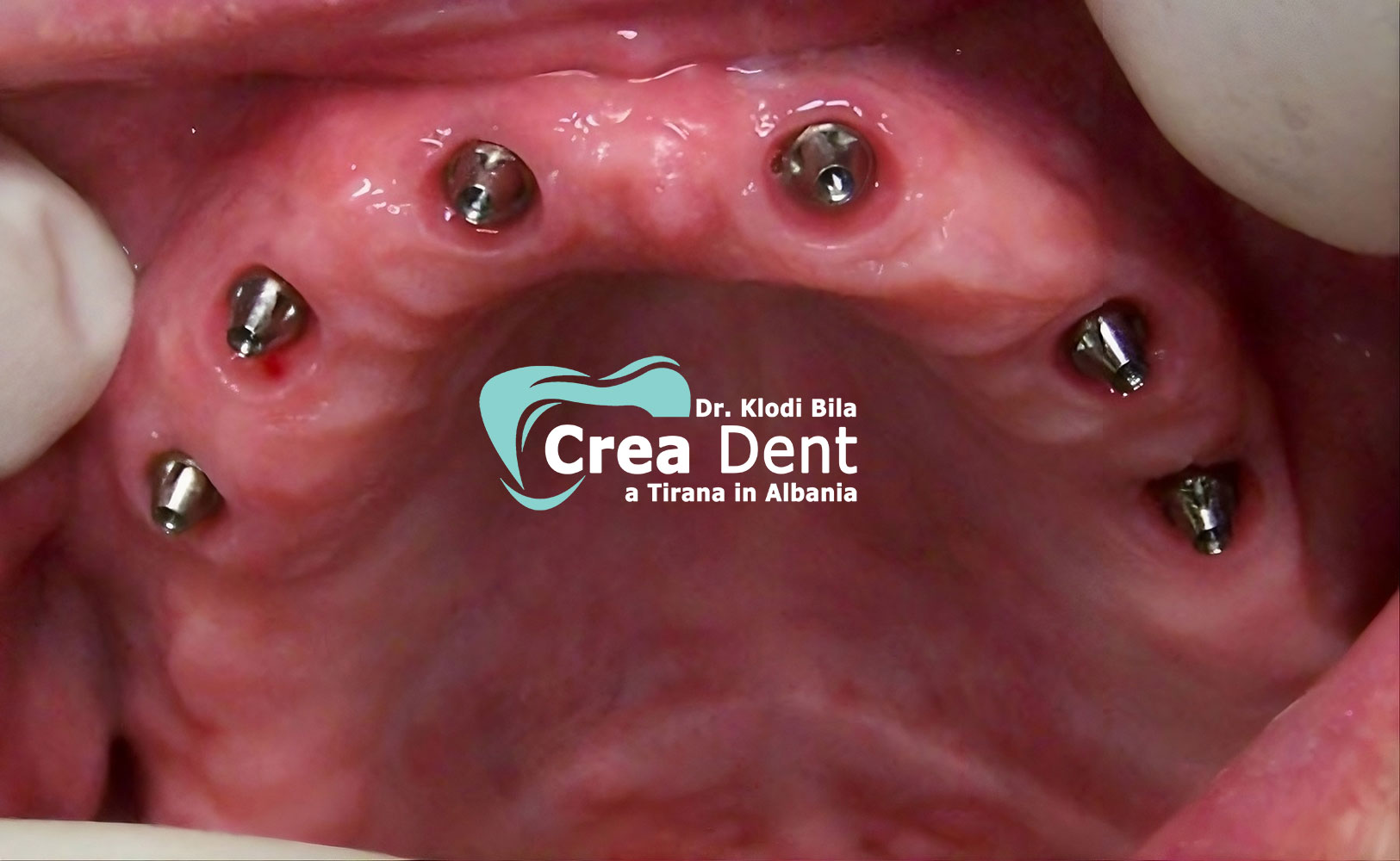 denti-corone-in-zirconio-per-estetica-dentale