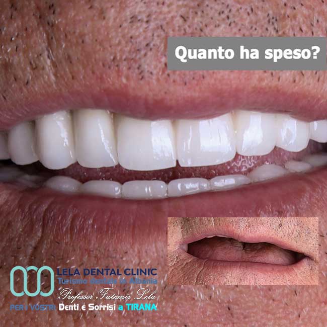 estrazione-dei-denti-con-implantologia-di-12-impianti-dentali-con-corone-in-zirconio
