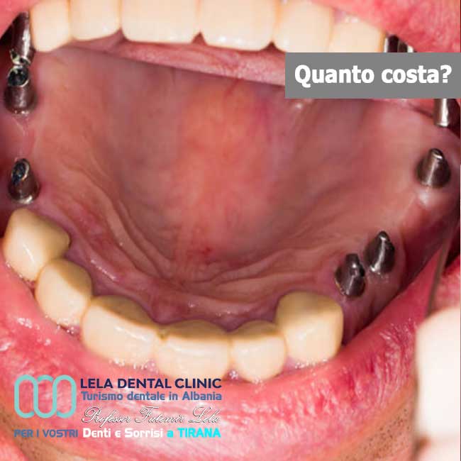 Impianti-dentali-per-ripristino-arcate-dentali