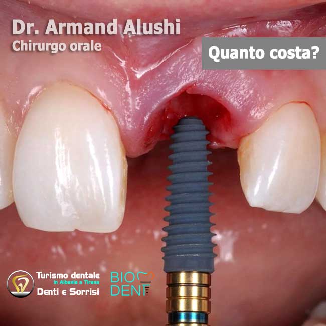 Impianto-dentale-per-dente-singolo