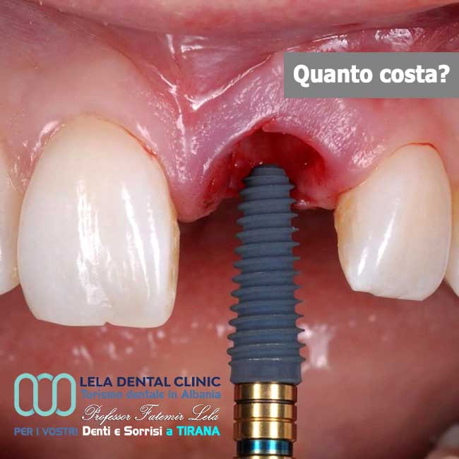 Impianto-dentale-albania-tirana