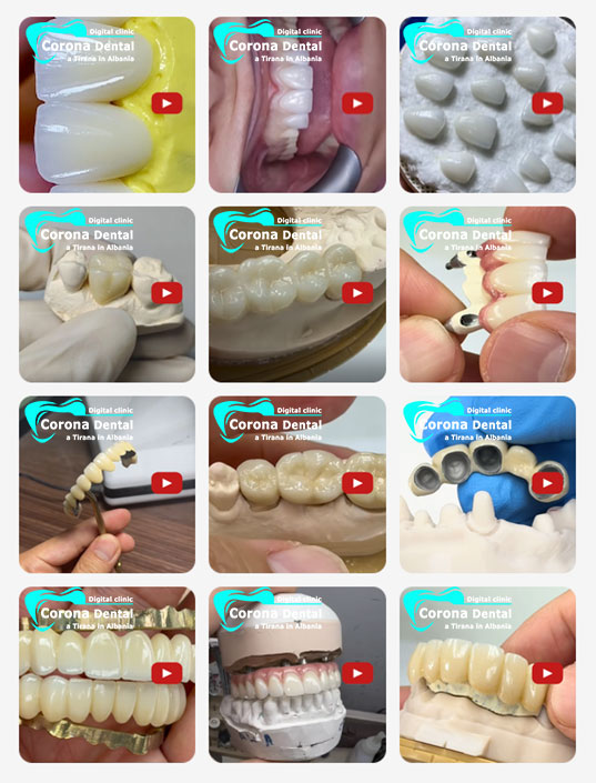 protesi-dentali-in-zirconio