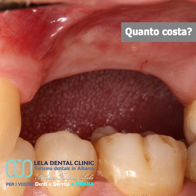 aumento-innesto-osso-per-posizione-dente