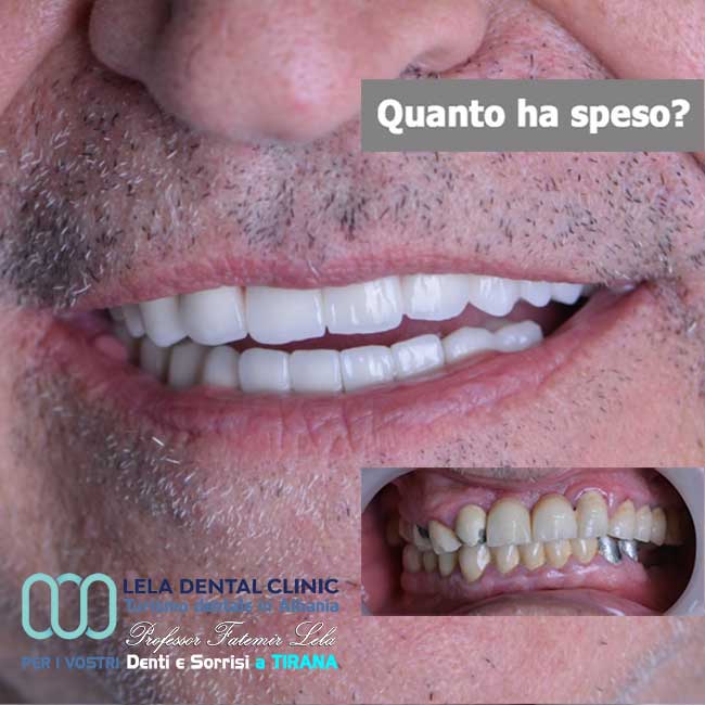 sostituzione-di-vecchie-corone-in-metallo-ceramica-con-24-corone-in-zirconio-con-cure-dentali