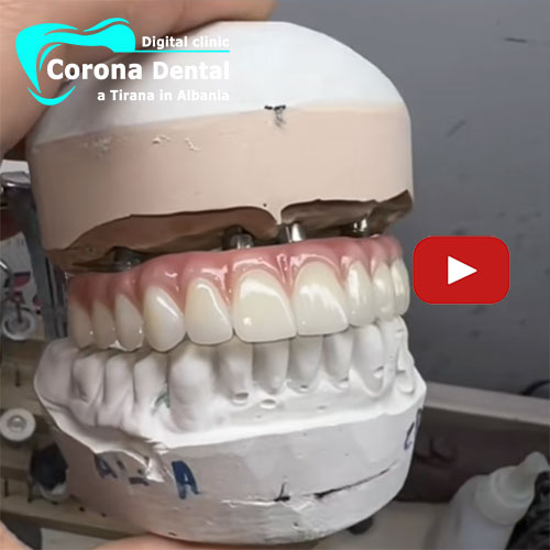 arcata-dentale-con-denti-in-zirconio-con-gengive-per-impianti-dentali.jpg