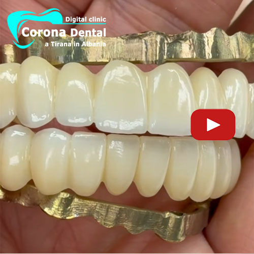 arcata-dentale-con-denti-in-zirconio-per impianti-dentali