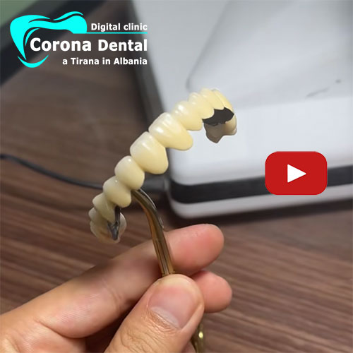arcata-dentale-in-metallo-ceramica