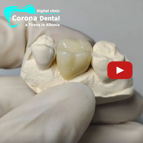 corona-in-zirconio