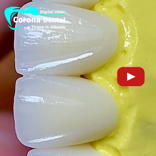 estetica-dentale-con-corone-in-zirconio