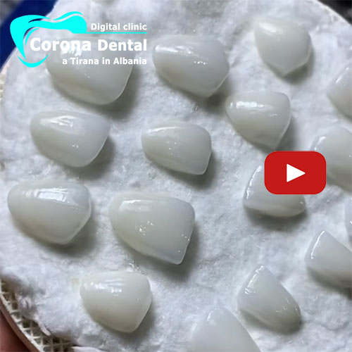 corone-in-zirconio-stradificate